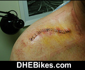 Click on the image for more info and a larger downhill mountain biking injury picture of Downhill Dave's Centipede