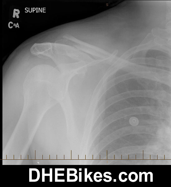 Downhill Dave's downhill mountain biking injury picture