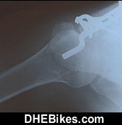 Click on the image for more info and a larger downhill mountain biking injury picture