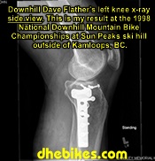 Click on the image for more info and a larger downhill mountain biking injury picture