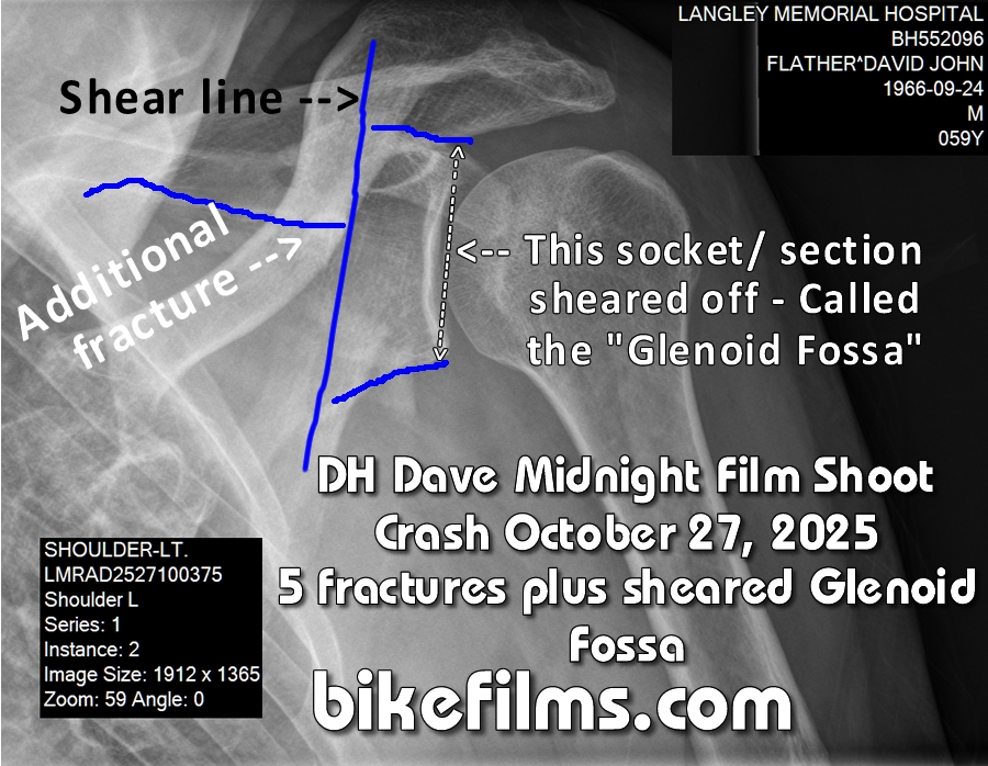 Pic of DH Dave's shatterred left scapula that happened on a midnight film shoot off a stump jump in Langley, BC