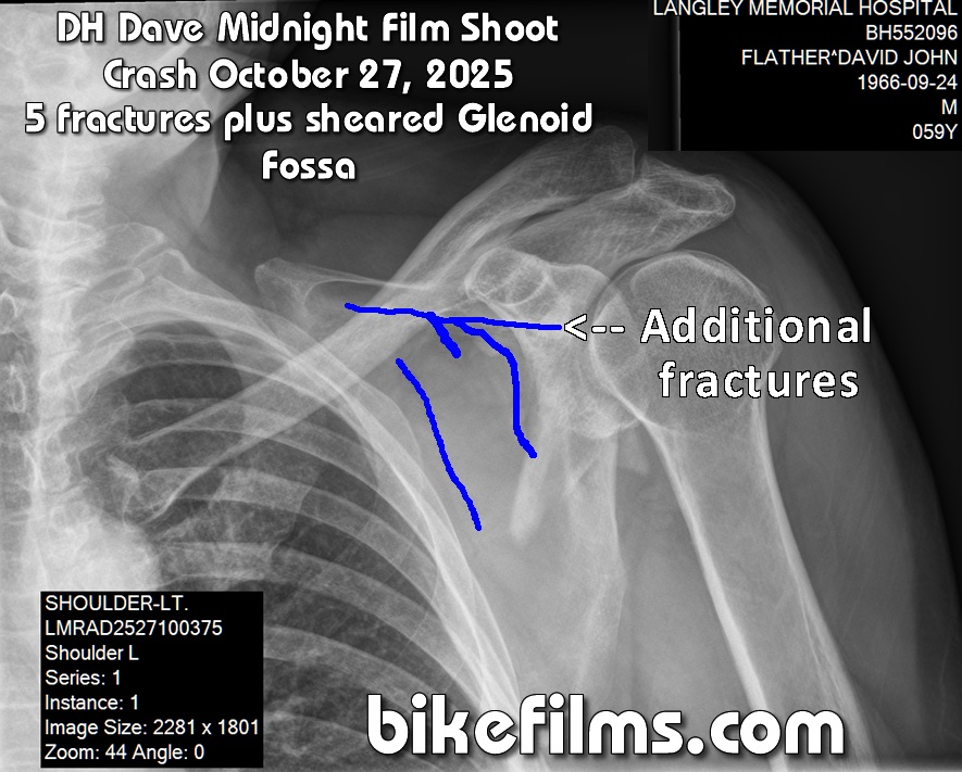  a pic of DH Dave's shatterred left scapula that happened on a midnight film shoot off a stump jump in Langley, BC